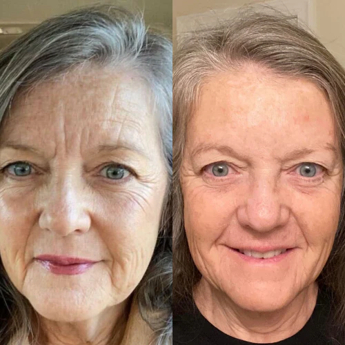 Forehead & Between Eyes Facial Patches - Image 10