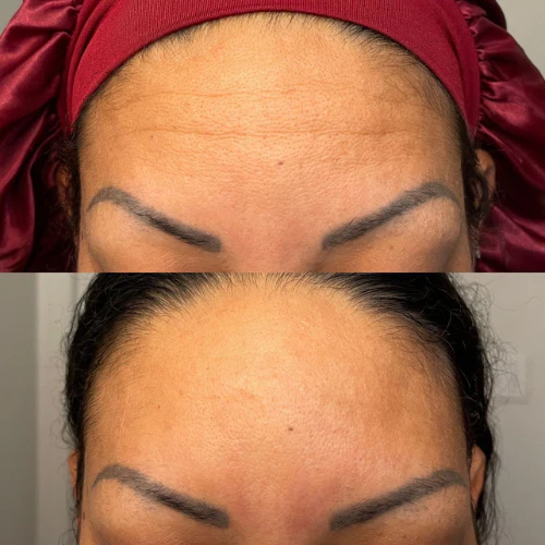 Forehead & Between Eyes Facial Patches - Image 12