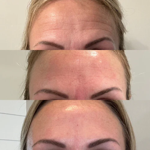 Forehead & Between Eyes Facial Patches - Image 13